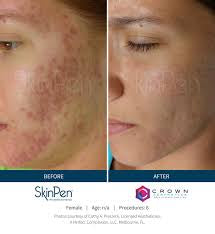Microneedling